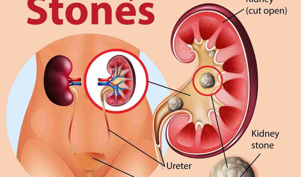 Bladder Calculi