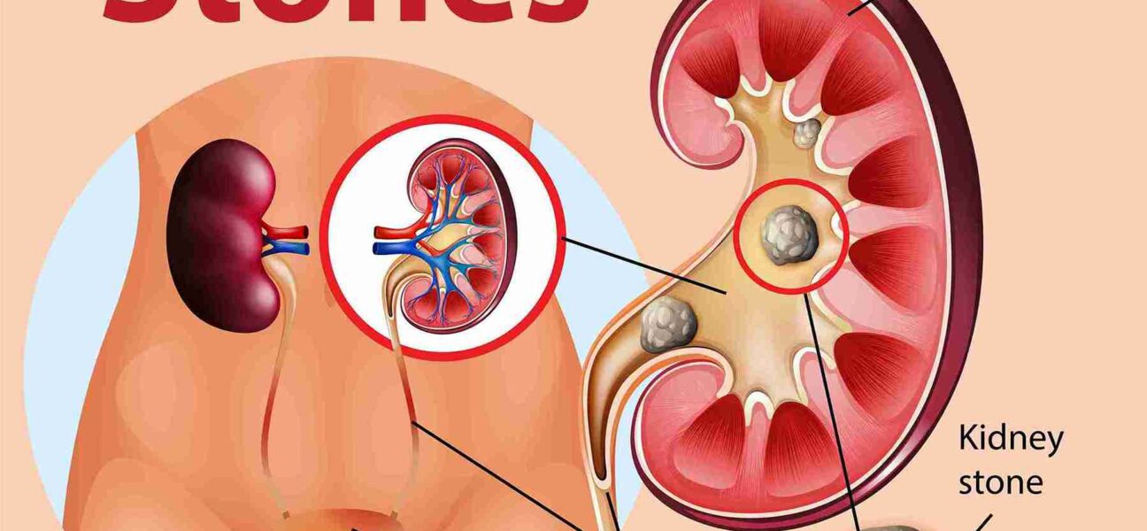 Bladder Calculi