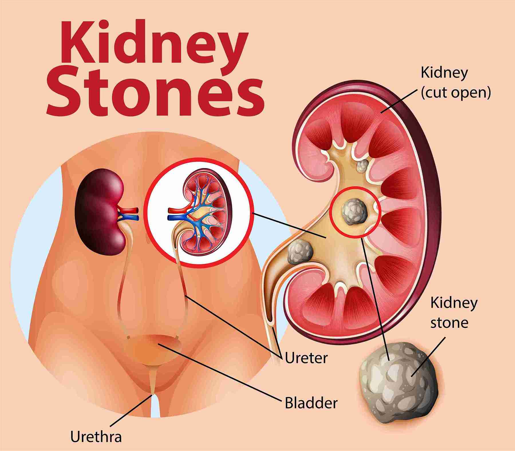 Bladder Calculi