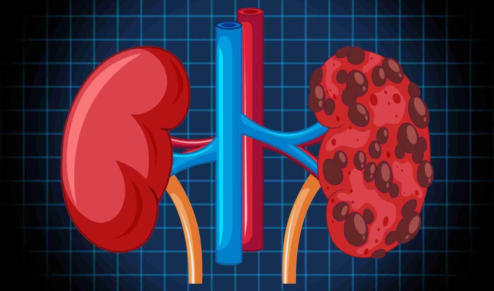 Renal Replacement Therapy: