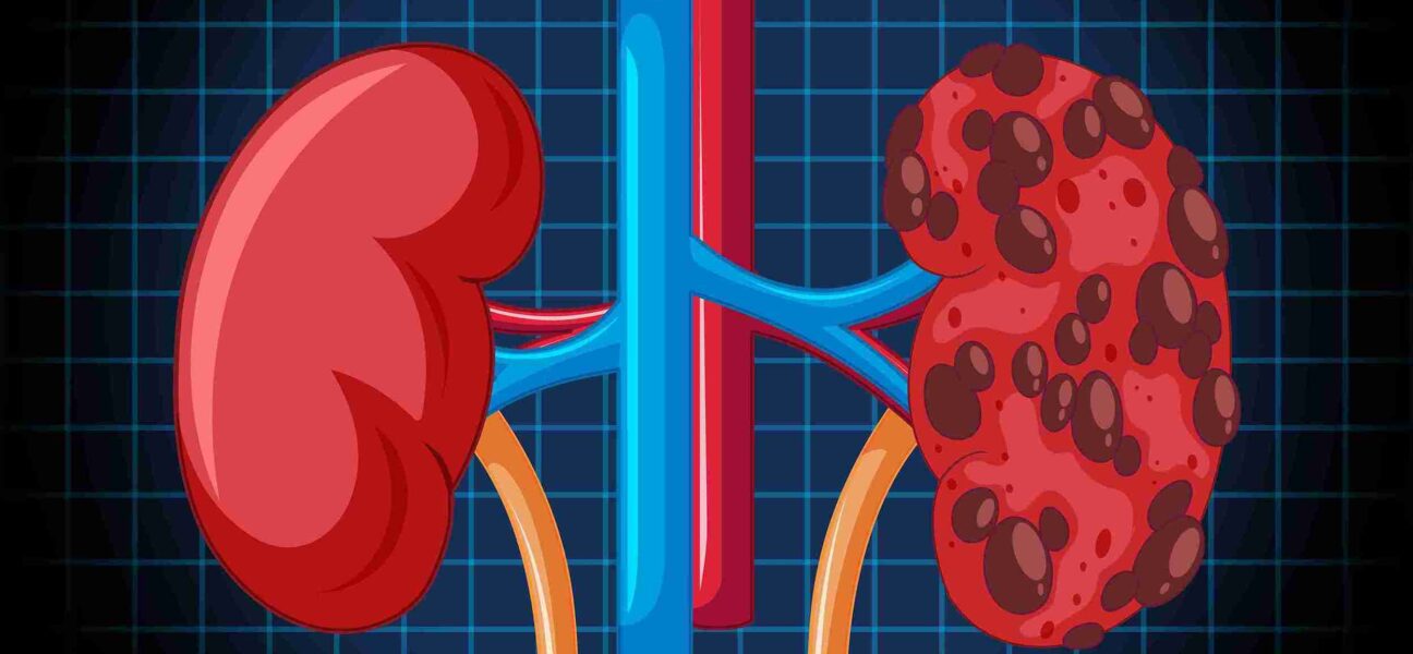 Renal Replacement Therapy: