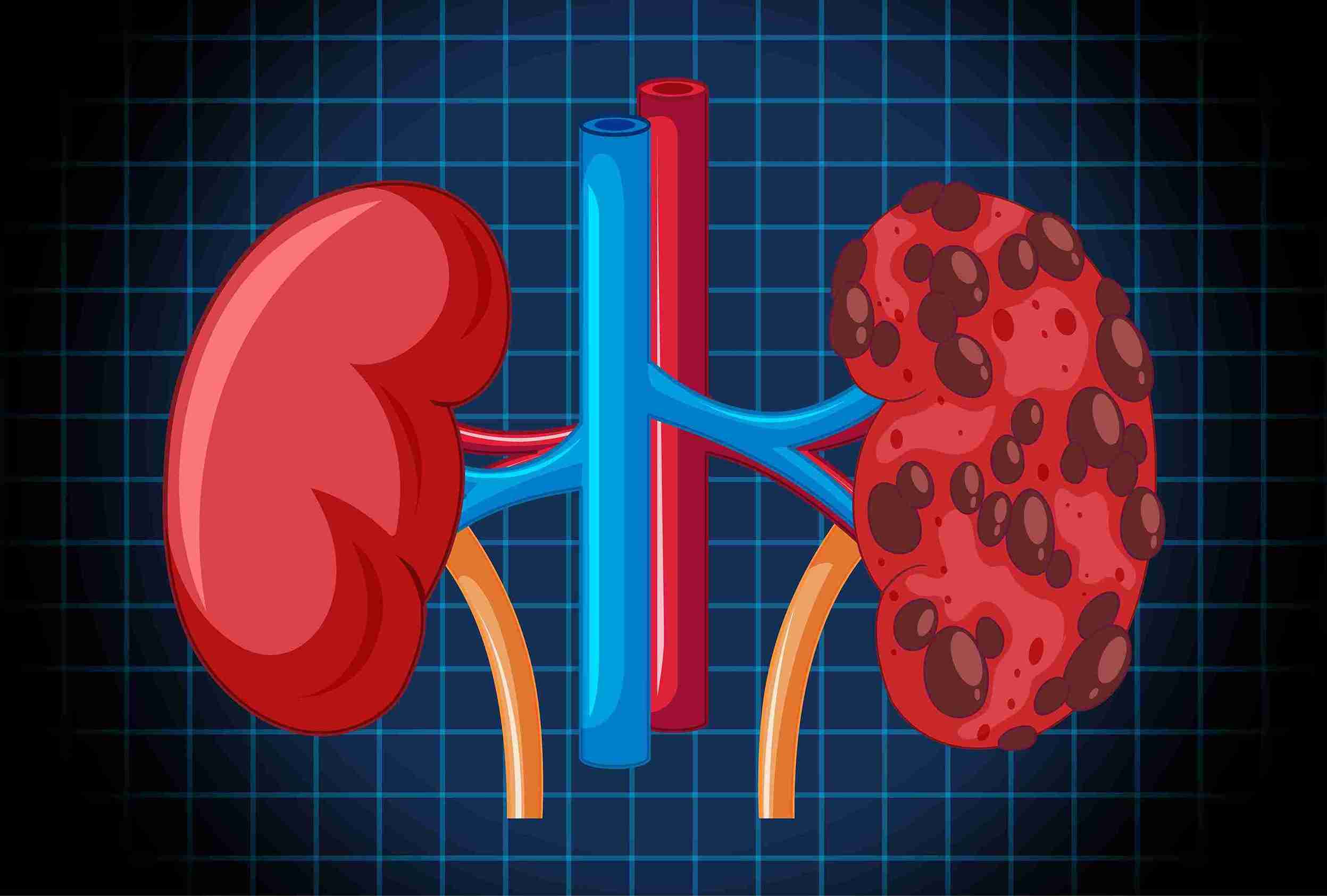 Renal Replacement Therapy: