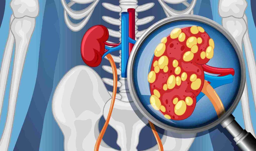 kidney biopsy