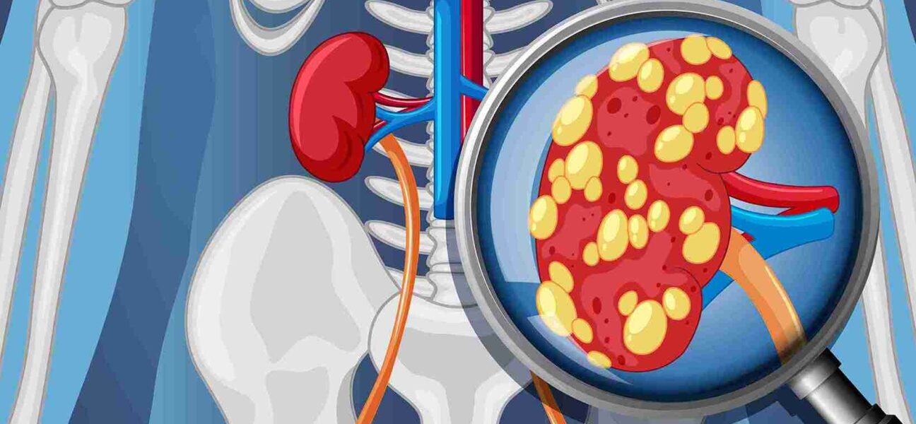 kidney biopsy