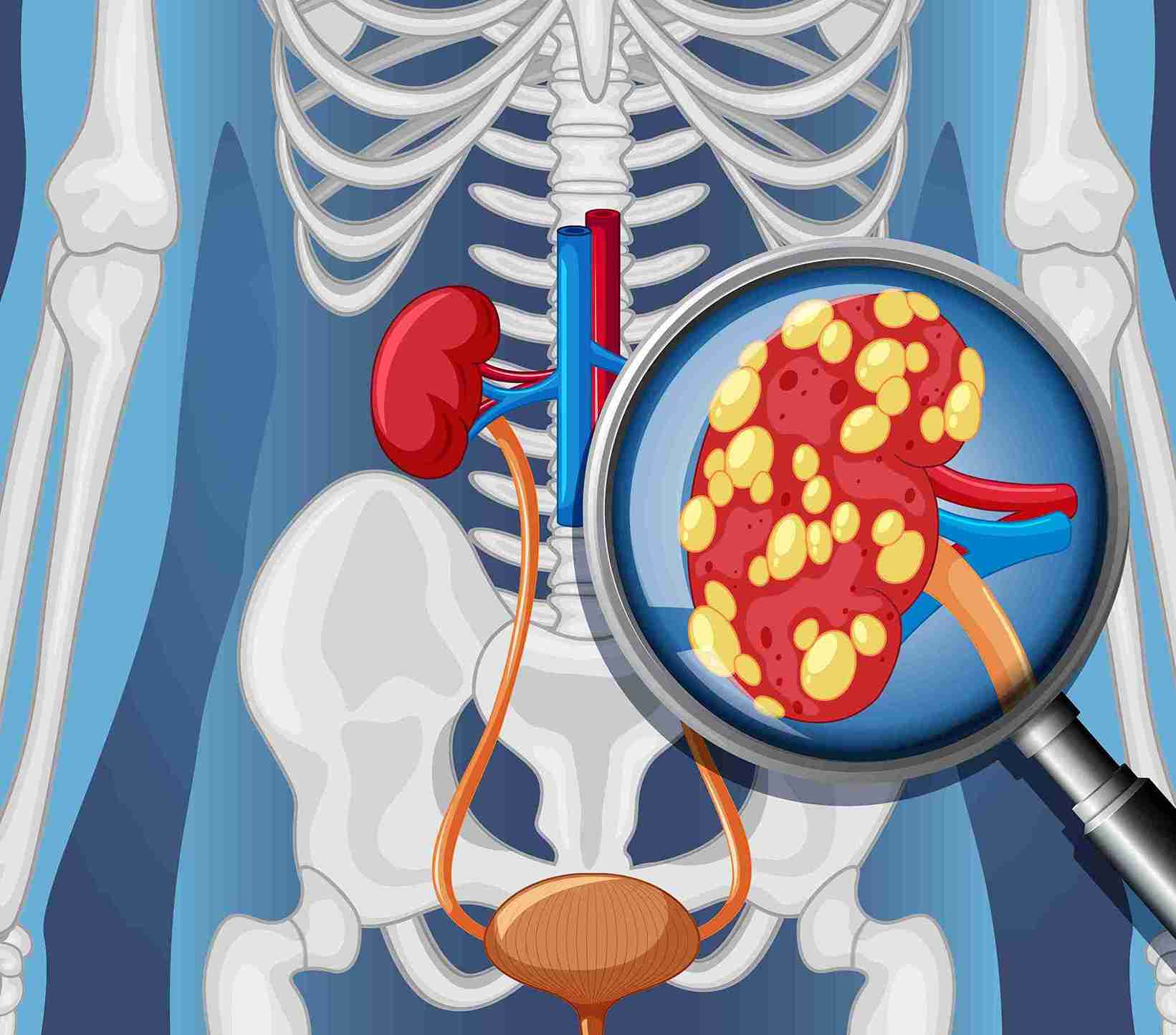 kidney biopsy