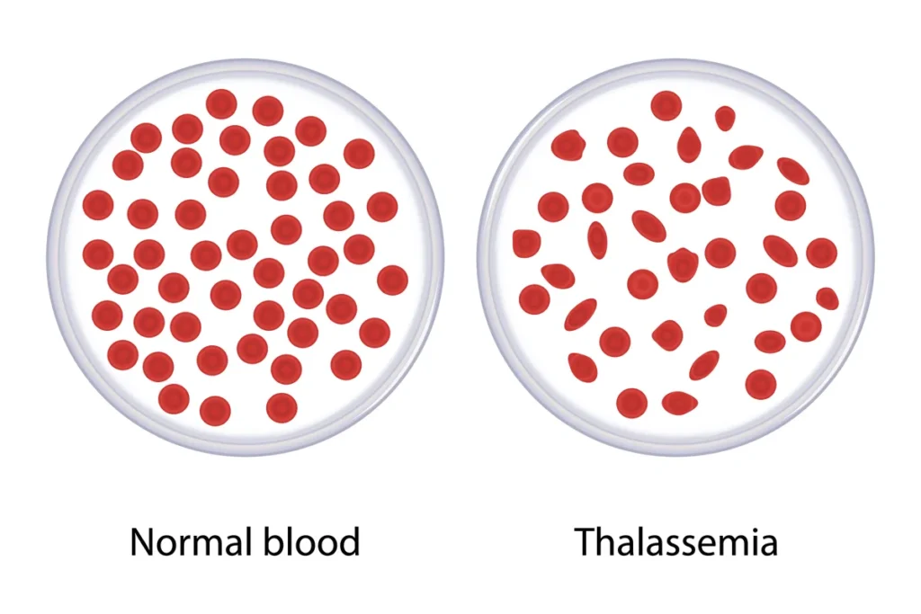 blood tests for thalassemia