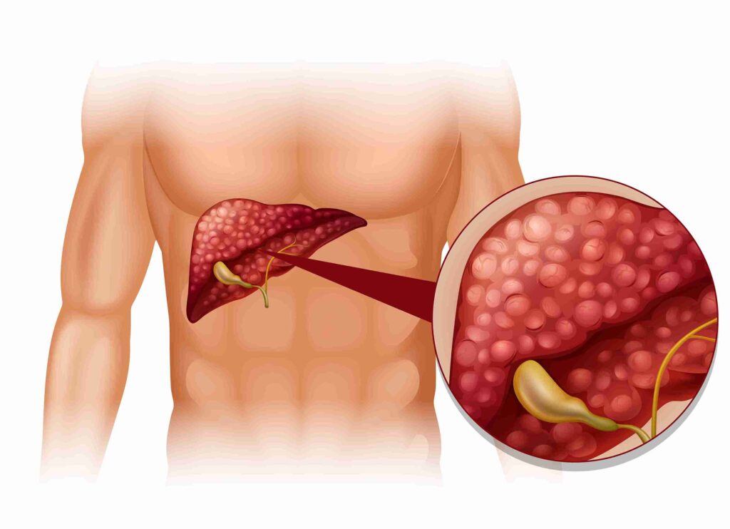 pyogenic liver abscess