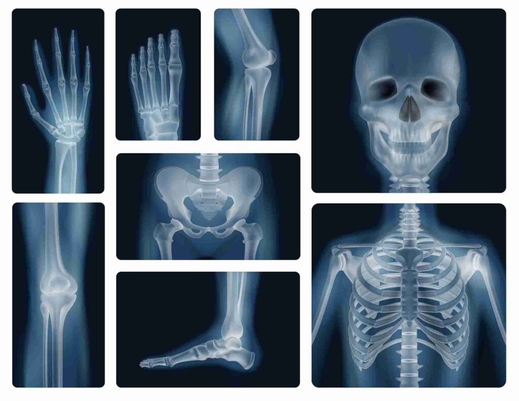 x-rays for the diagnosis of thalassemia