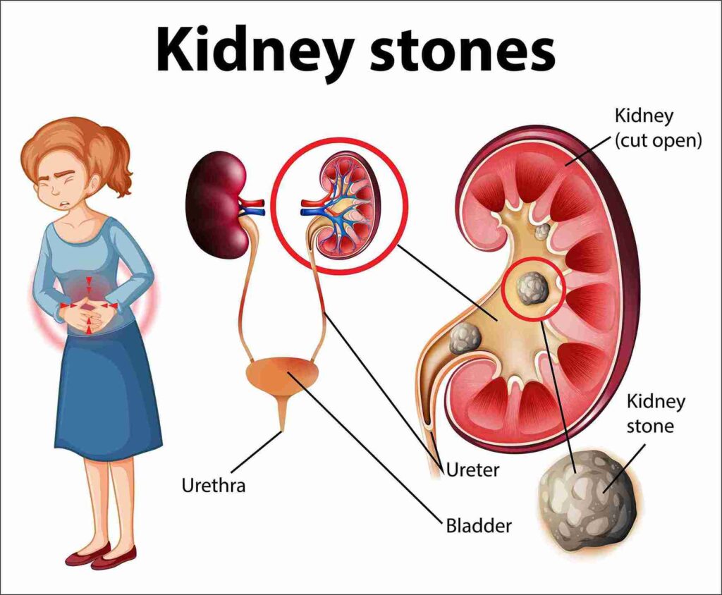 symptoms of bladder calculi