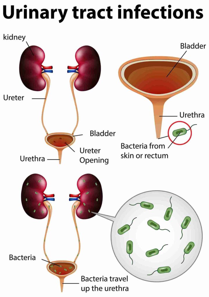 infection due to kidney biopsy