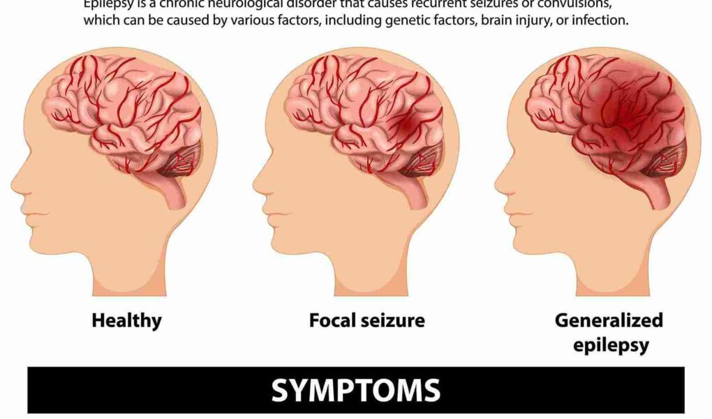 Epilepsy