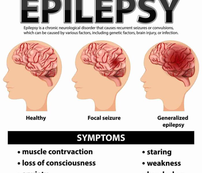 Epilepsy