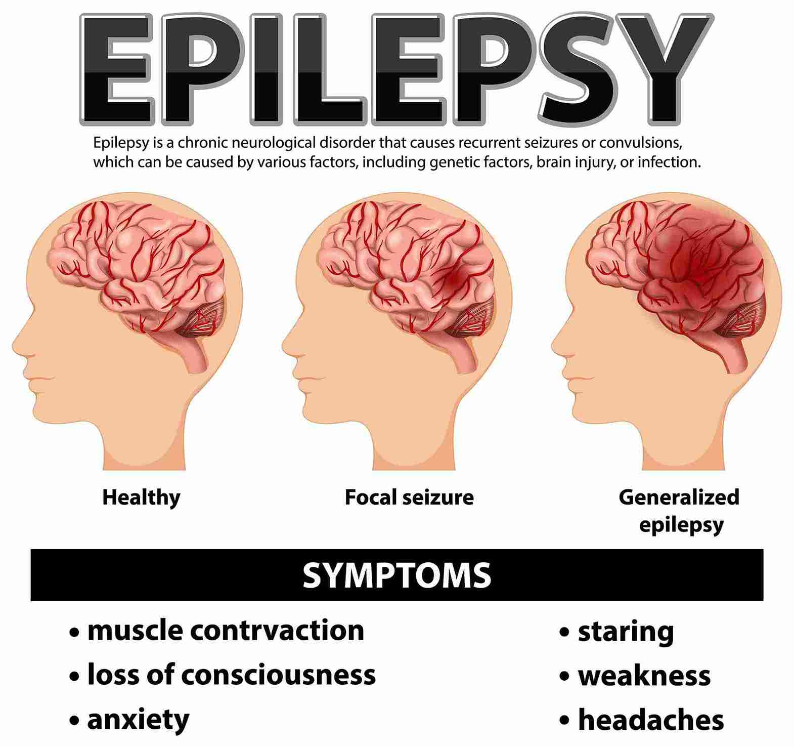 Epilepsy