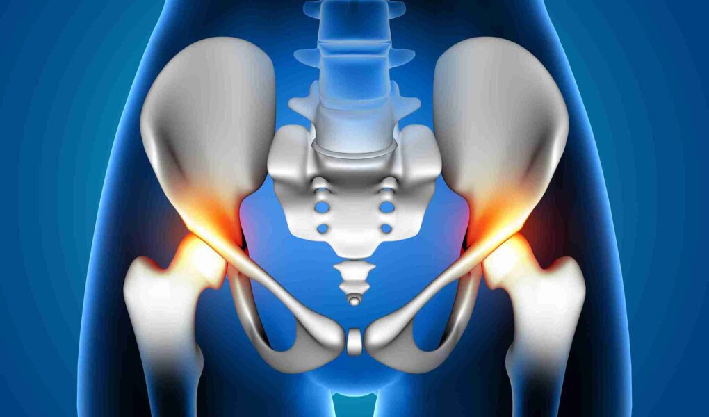 trochanteric bursitis