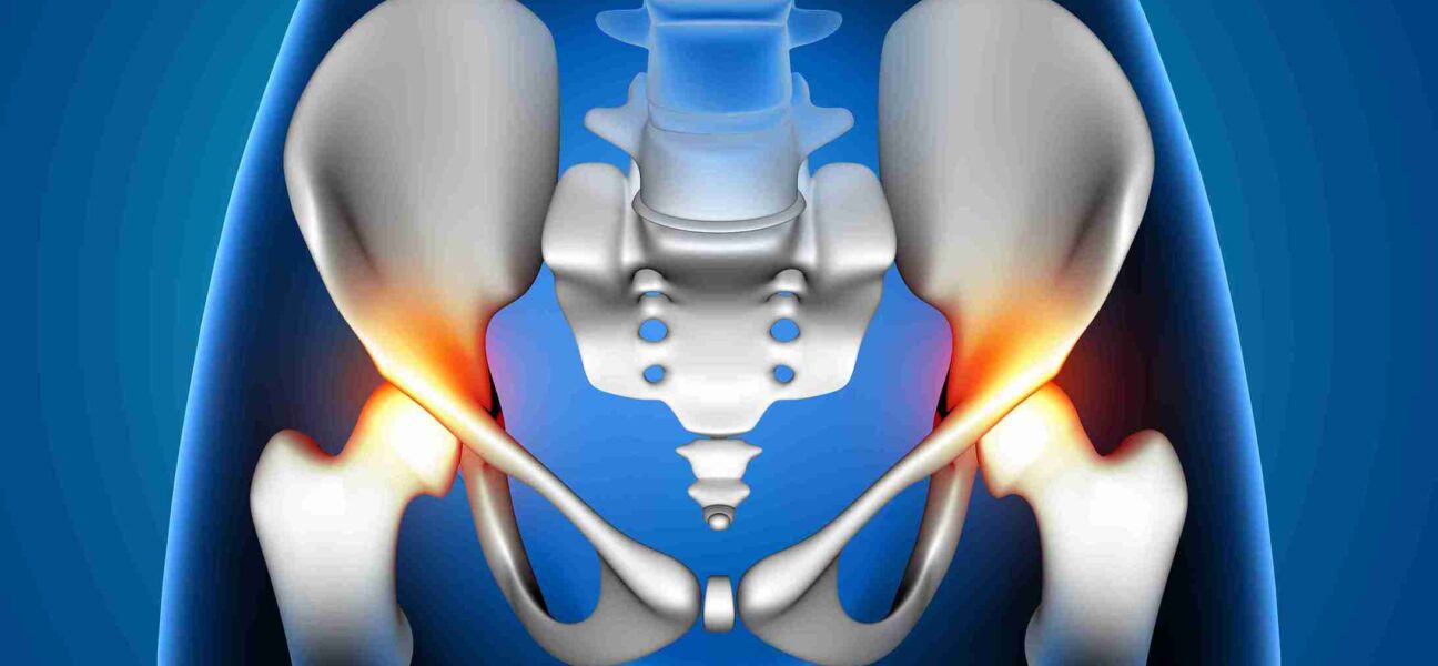 trochanteric bursitis