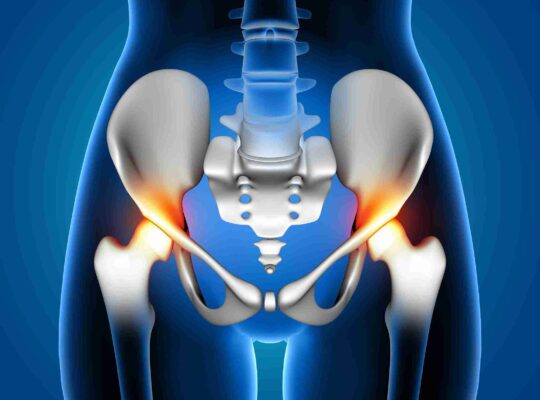 trochanteric bursitis