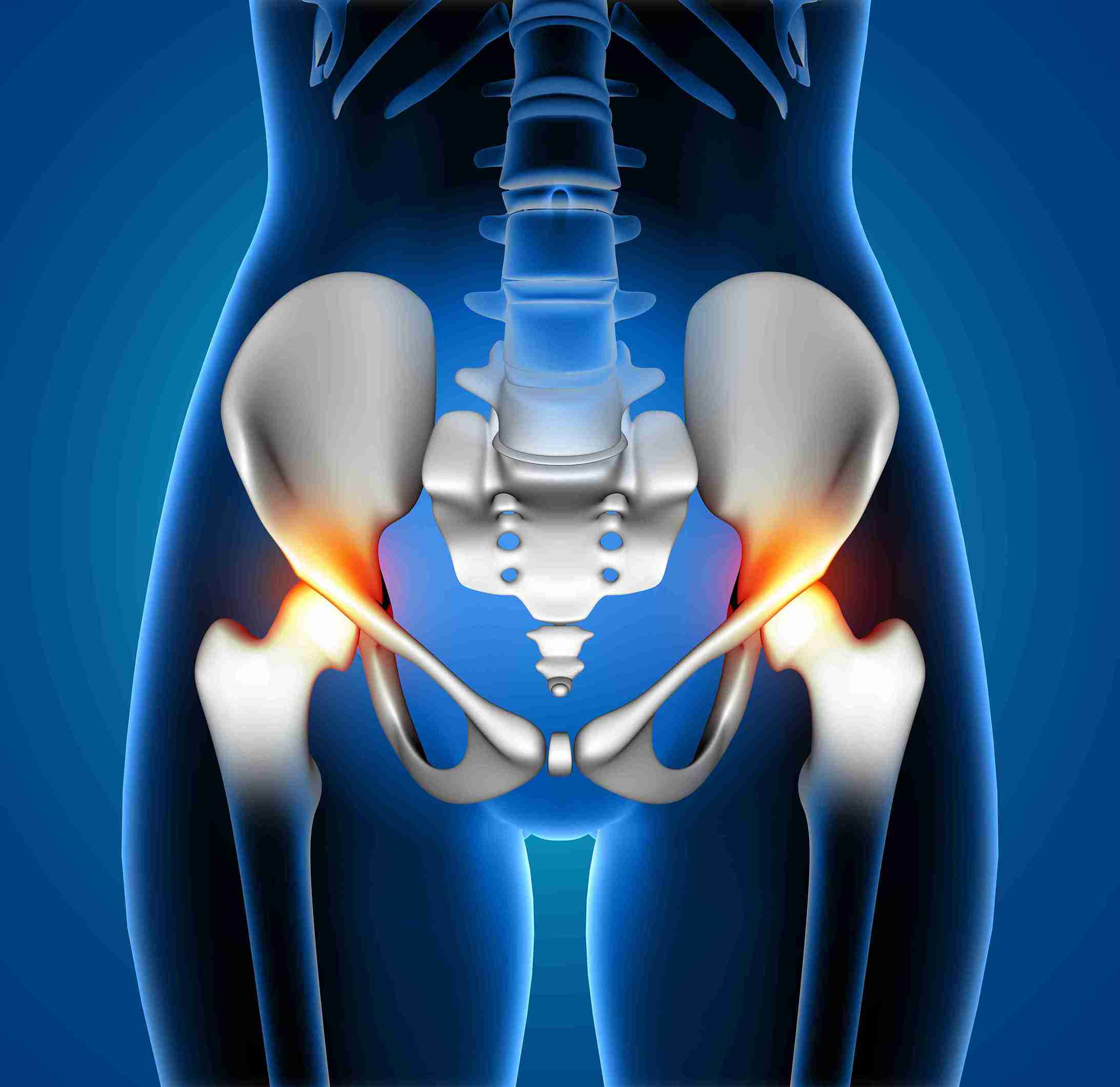 trochanteric bursitis